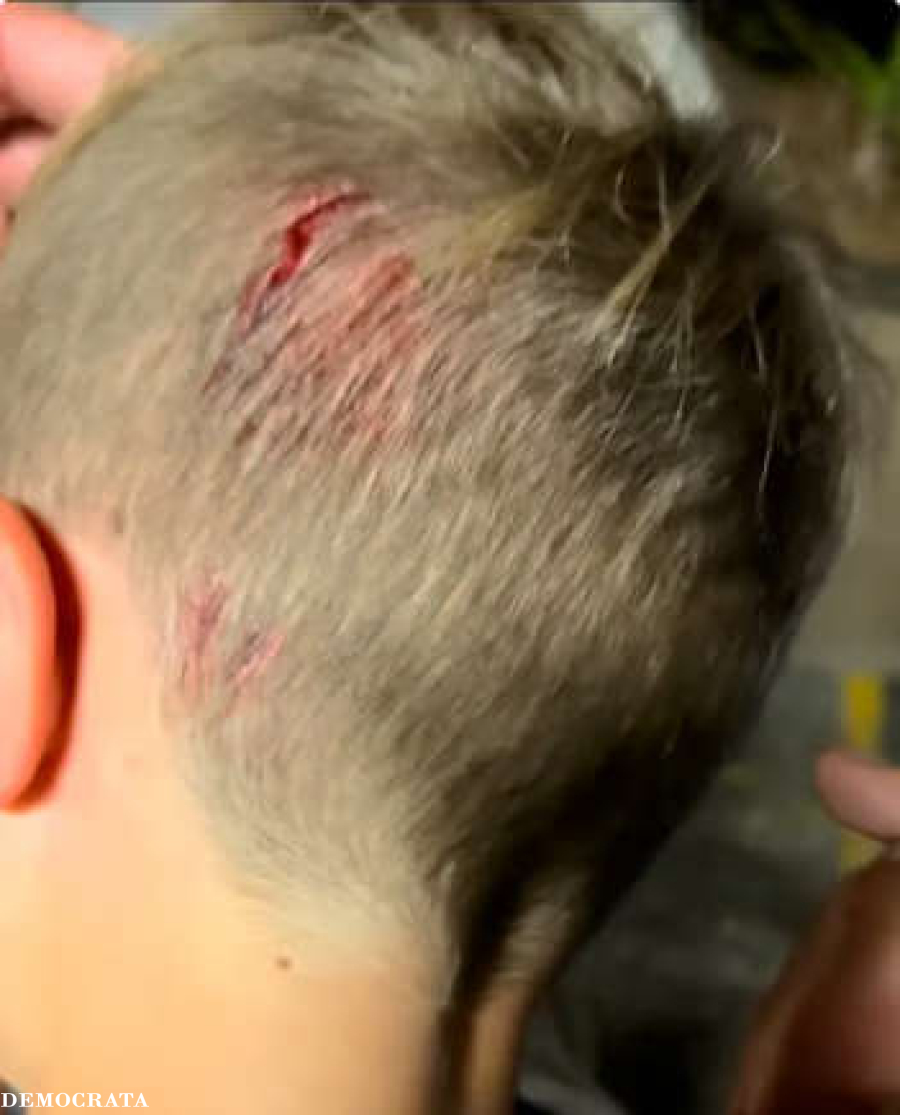 Menino é mordido na cabeça por cobra em passeio: “Aconteceu tão rápido”